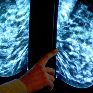 Preserving breast tissue will aid cancer research
