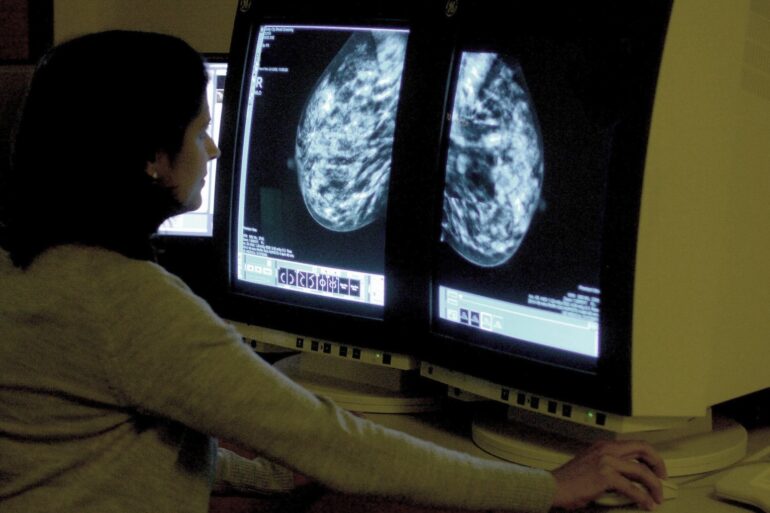 AI Could Detect Heart Risk From Breast Screening Images Study Suggests