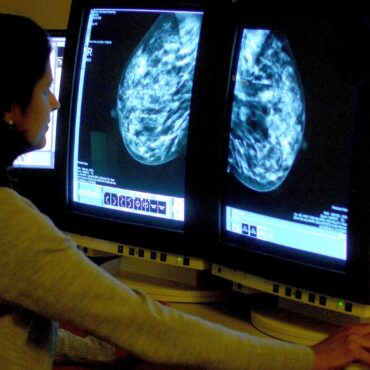 New Test Could Revolutionise Aftercare For Thousands Of Breast Cancer Patients