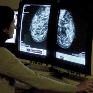 AI Could Detect Heart Risk From Breast Screening Images Study Suggests