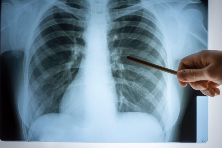 Children With Cancer To Have Travel Costs Paid Under New Government Scheme